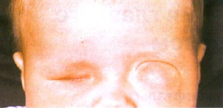 Mikroftalmos koos tsüstide moodustumisega (vasak silm). Anoftalmos (parem silm).