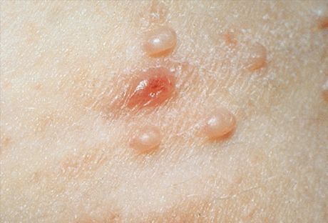 Molluscum contagiosum: foto