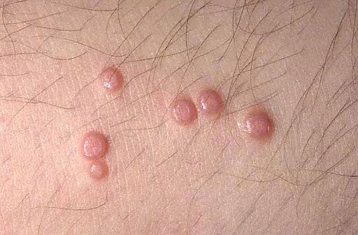 Molluscum contagiosum: foto